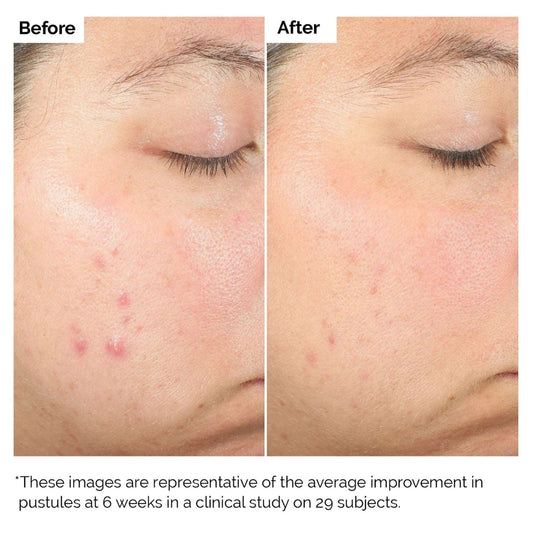 Salicylic Acid 2% Anhydrydrous solution